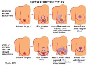 BREAST-REDUCTION-INCISION